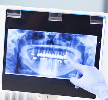 cavity detecting x rays